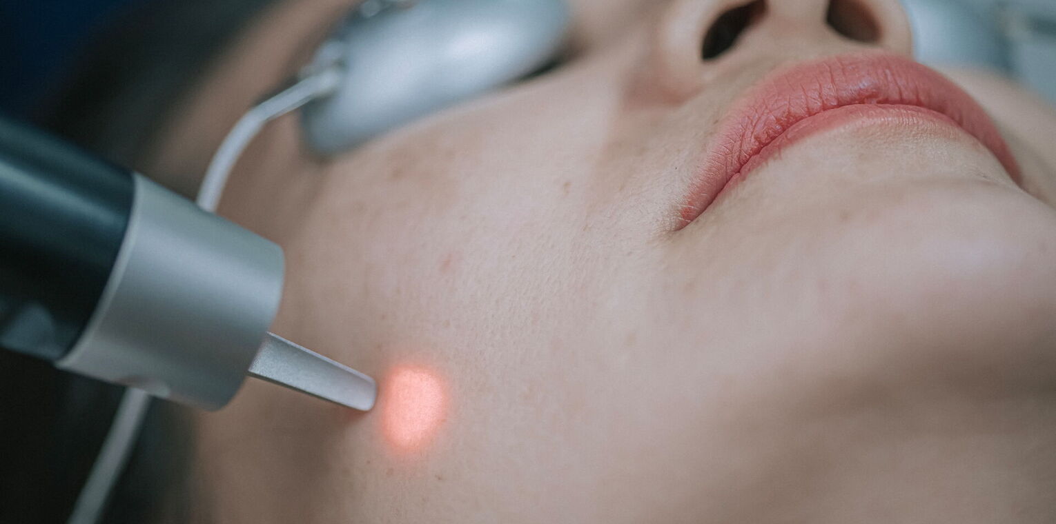 Bild zeigt Laserbehandlung eines Angioms