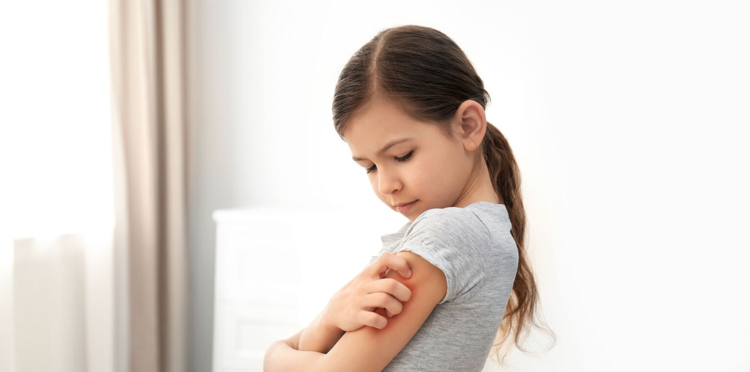 Bild zeigt ein Kind mit Ekzem am Arm