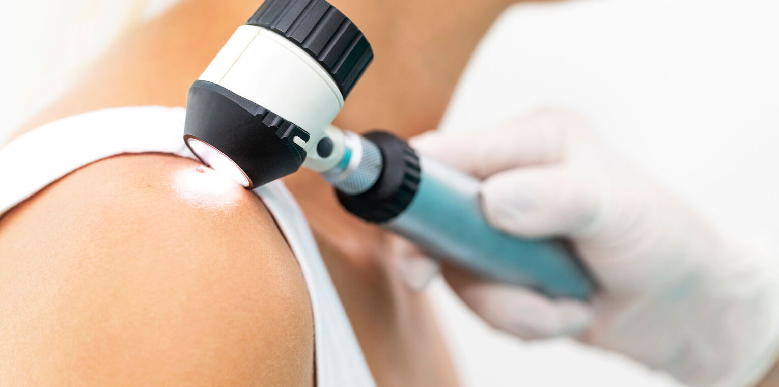 Bild zeigt die Untersuchung eines Pigmentmals/Muttermals mit einem Dermatoskop